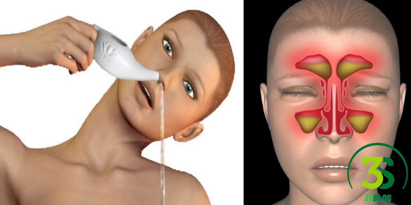 how to release sinus pressure fast