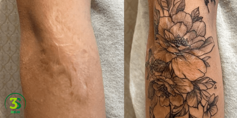 Covering Scars with Tattoos