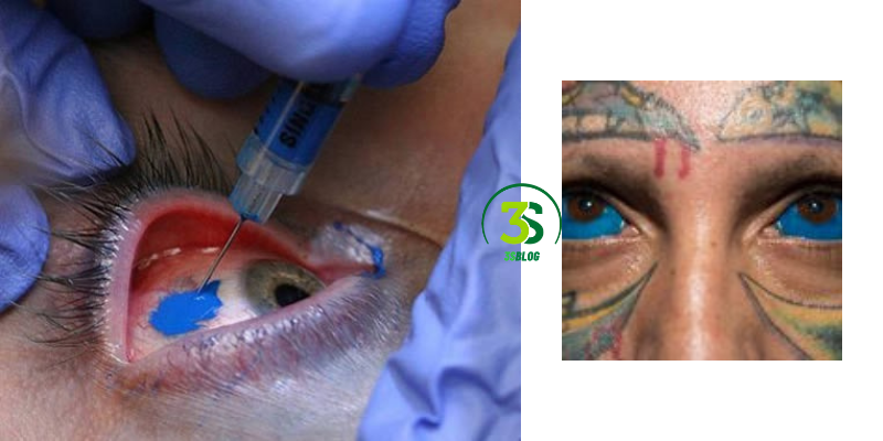 Tattooing the Whites of Your Eyes